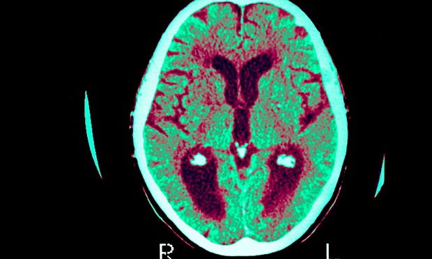 Alzheimer's disease brain scan